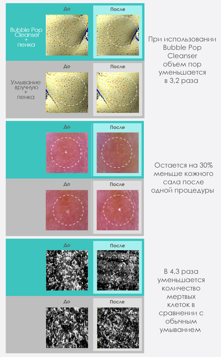 Размер пор при использовании VANAV Bubble Pop Cleanser заметно уменьшается